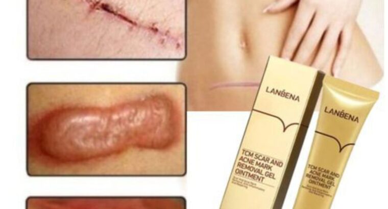 Lanbena Acne Scar Stretch Marks Keloids Pimples And Black Dark Spots Remover Treatment Cream.